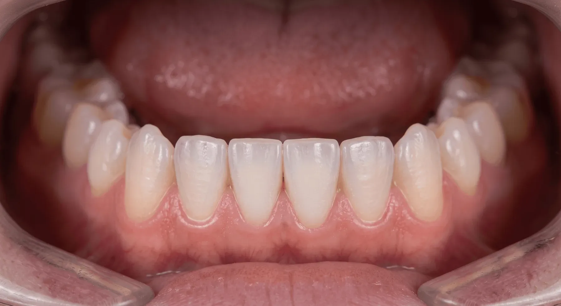 Treatment result after treatment