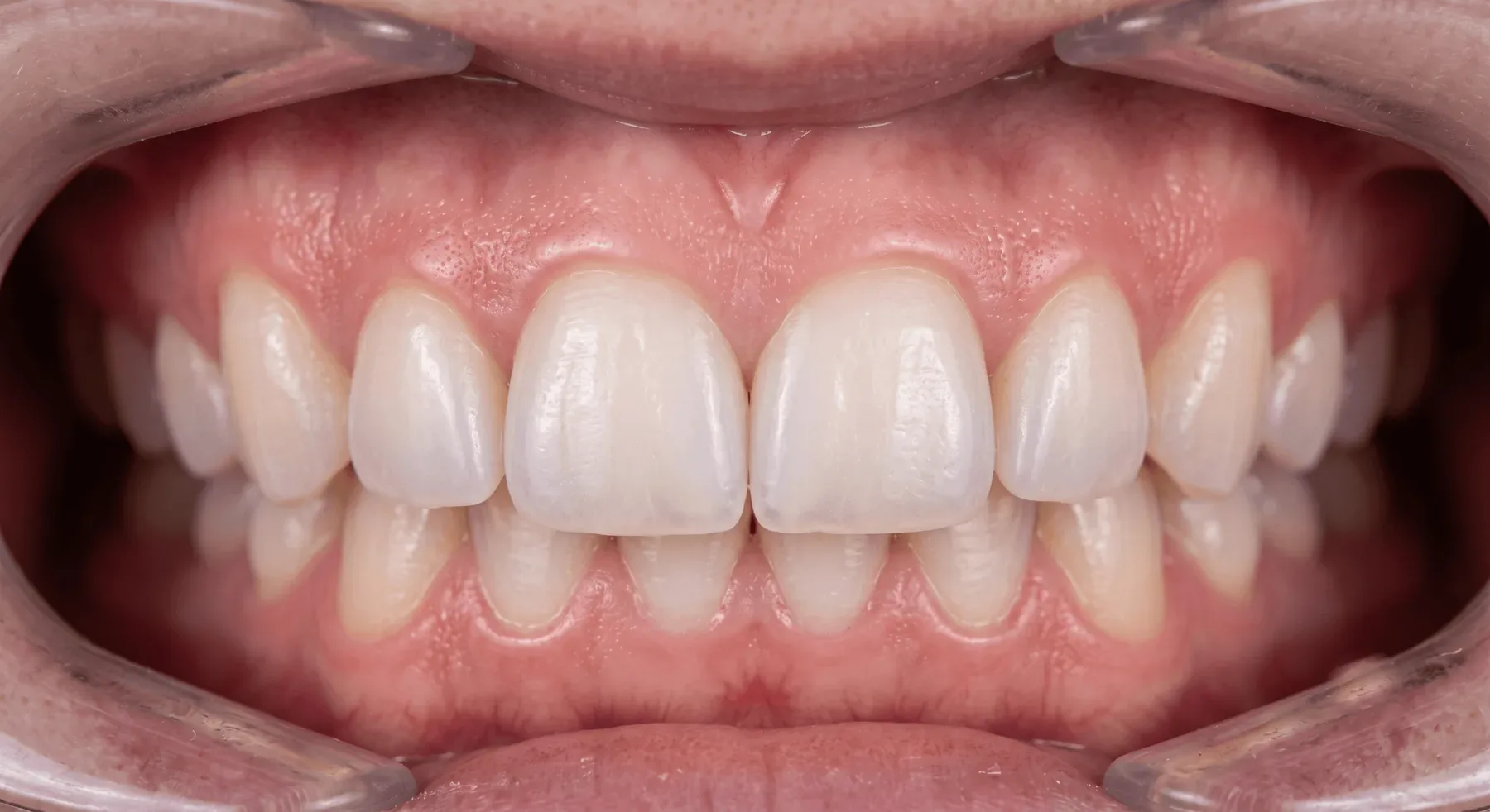 Treatment result after treatment