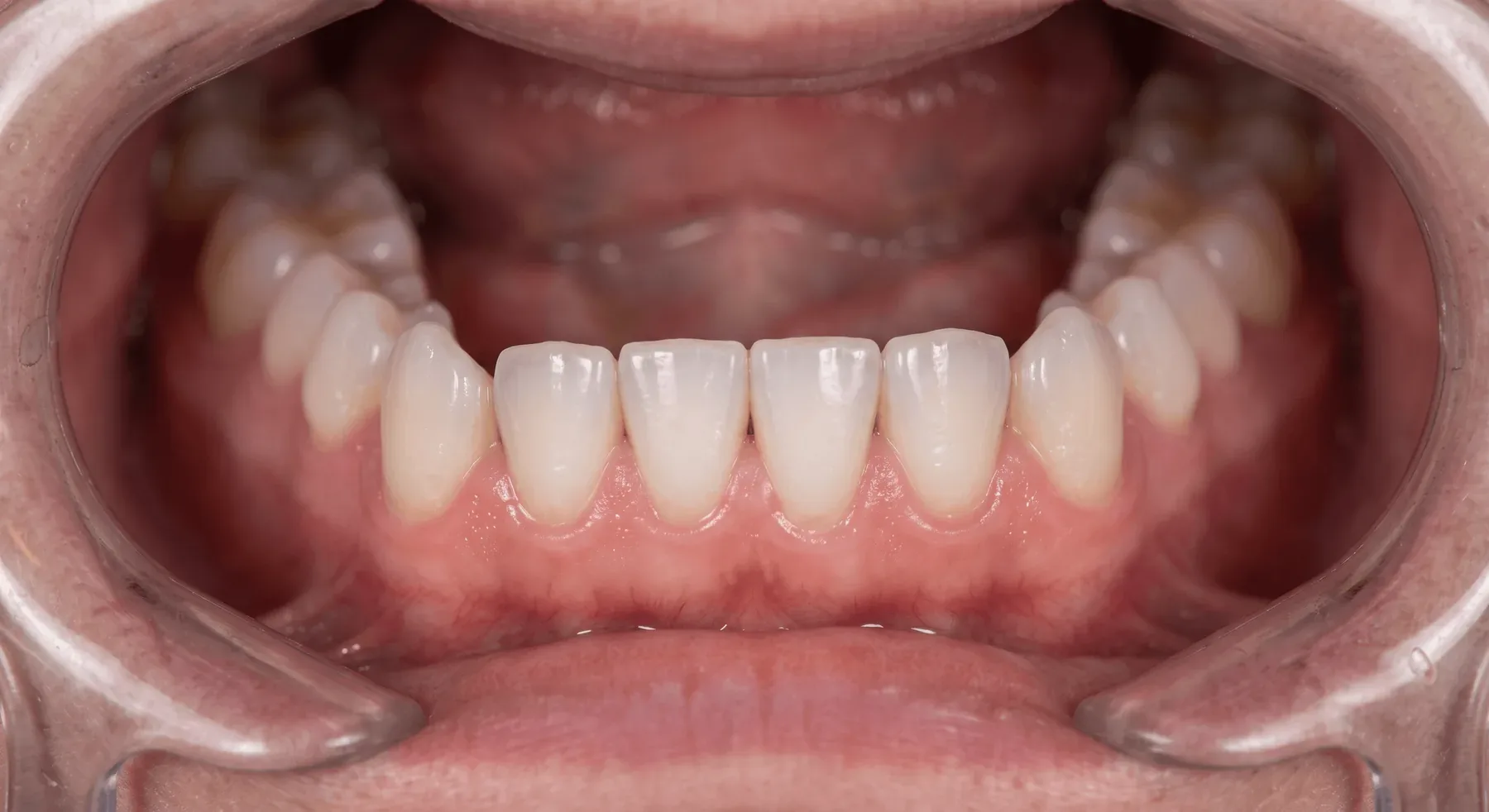 Treatment result after treatment